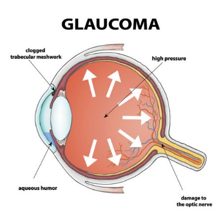 Picture for category GLAUCOMA