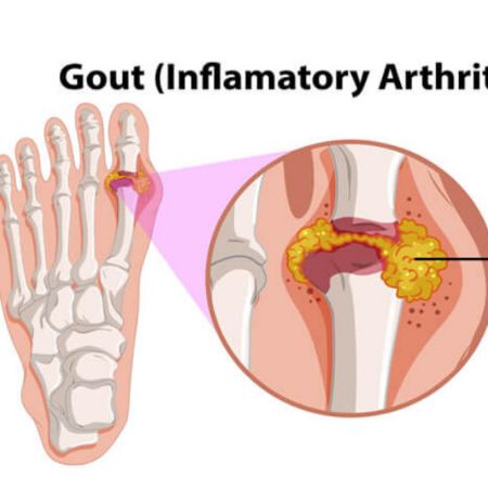 Picture for category RHEUMATIC DISEASE & GOUT