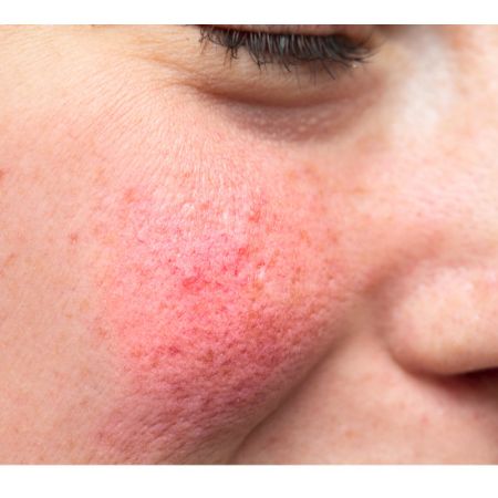 Picture for category ACNE AND ROSACEA